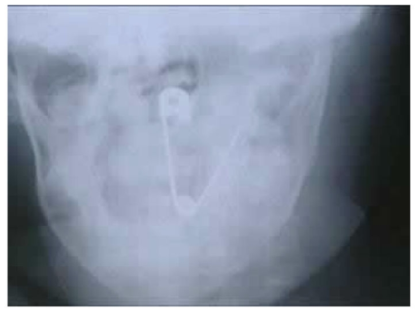 Los objetos más espeluznantes que se han encontrado en un estómago humano Los objetos más espeluznantes que se han encontrado en un estómago humano