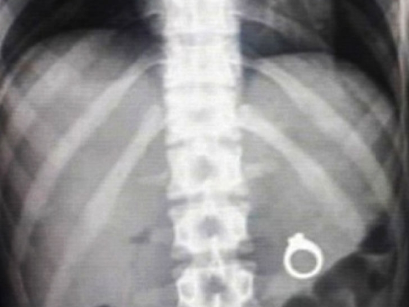 Los objetos más espeluznantes que se han encontrado en un estómago humano Los objetos más espeluznantes que se han encontrado en un estómago humano