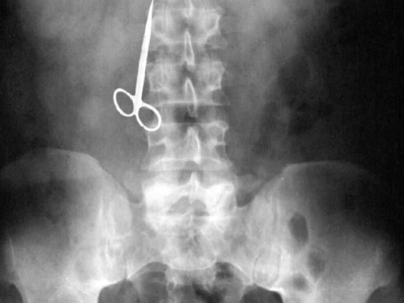 Los objetos más espeluznantes que se han encontrado en un estómago humano Los objetos más espeluznantes que se han encontrado en un estómago humano