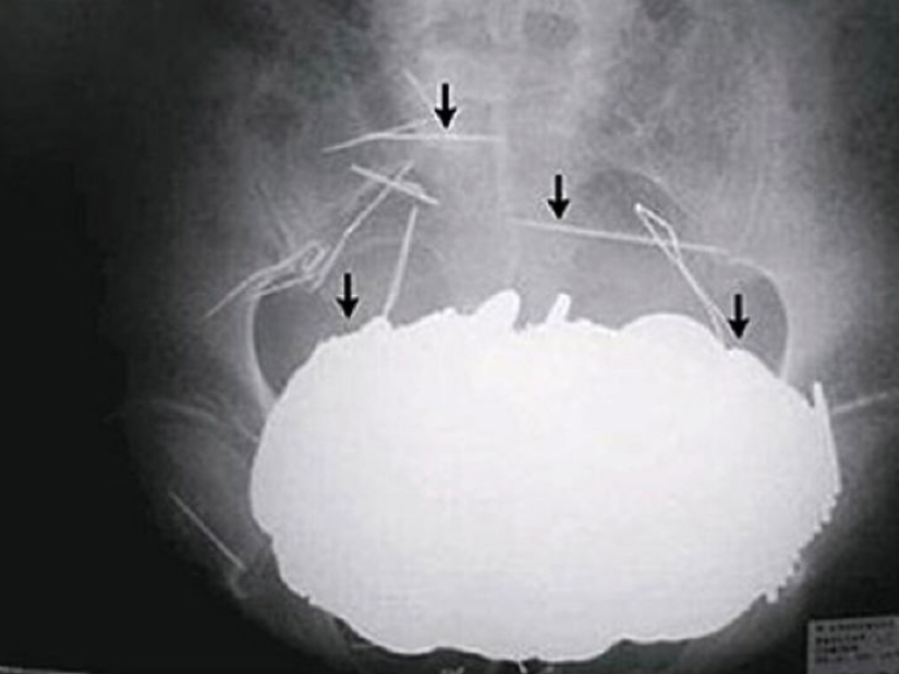 Los objetos más espeluznantes que se han encontrado en un estómago humano Los objetos más espeluznantes que se han encontrado en un estómago humano