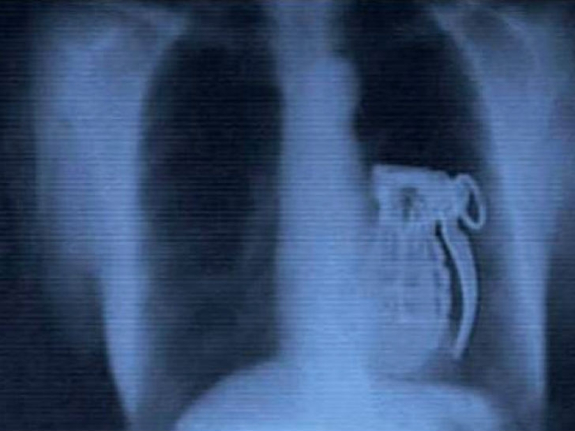 Los objetos más espeluznantes que se han encontrado en un estómago humano Los objetos más espeluznantes que se han encontrado en un estómago humano