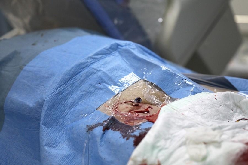 Matters of the Heart, or Operation Without Cuts Matters of the Heart, or Operation Without Cuts