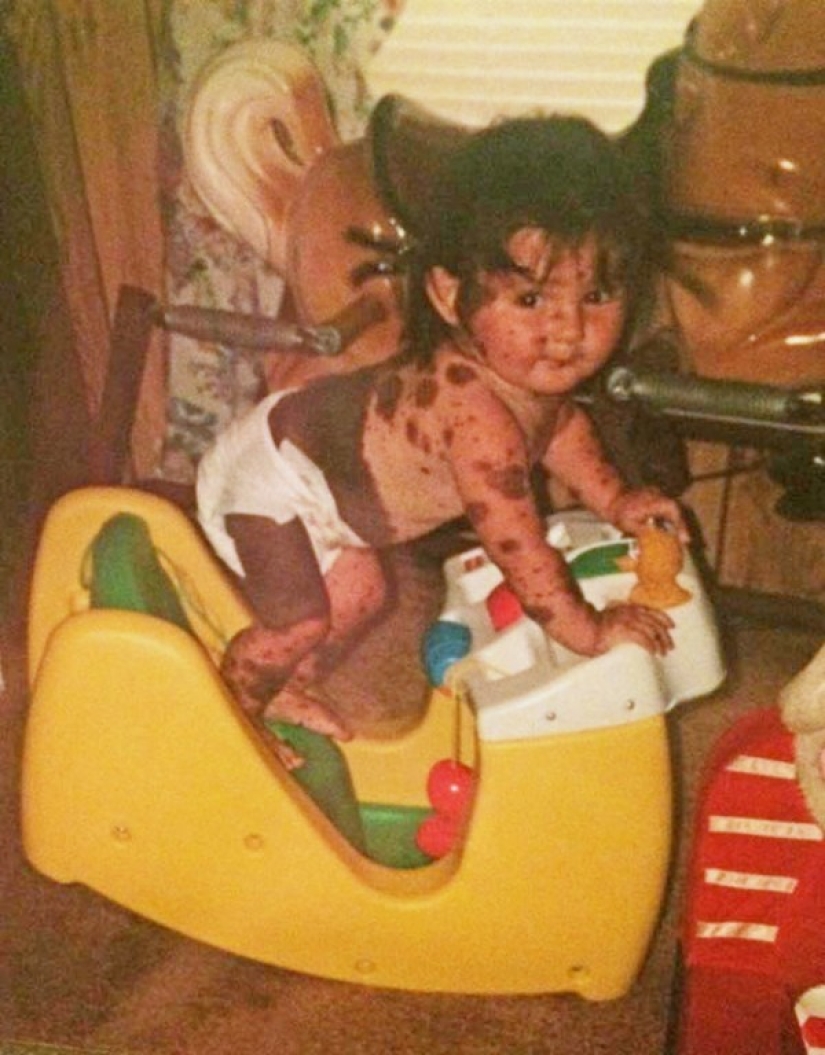 Niña con condición rara de la piel se enorgullece de ser diferente Niña con condición rara de la piel se enorgullece de ser diferente