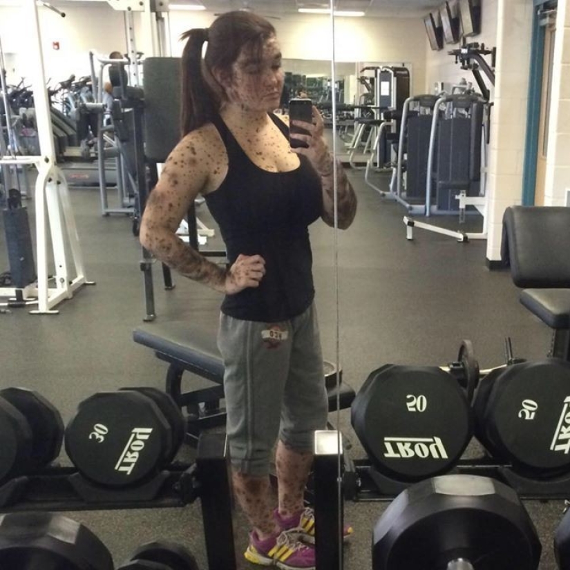 Niña con condición rara de la piel se enorgullece de ser diferente Niña con condición rara de la piel se enorgullece de ser diferente