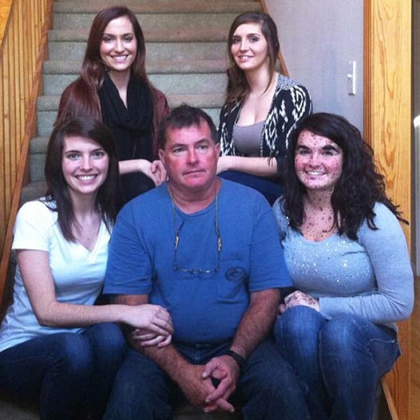 Niña con condición rara de la piel se enorgullece de ser diferente Niña con condición rara de la piel se enorgullece de ser diferente