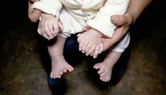 Niño chino nació con 31 dedos Niño chino nació con 31 dedos