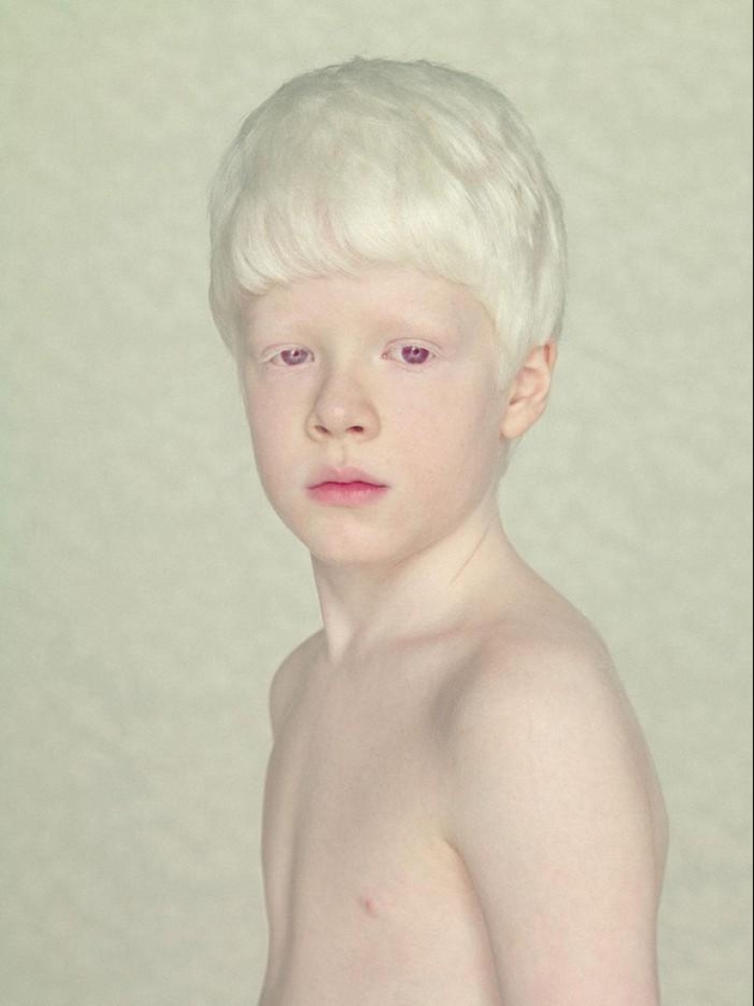 Not like everyone else: albino people Not like everyone else: albino people