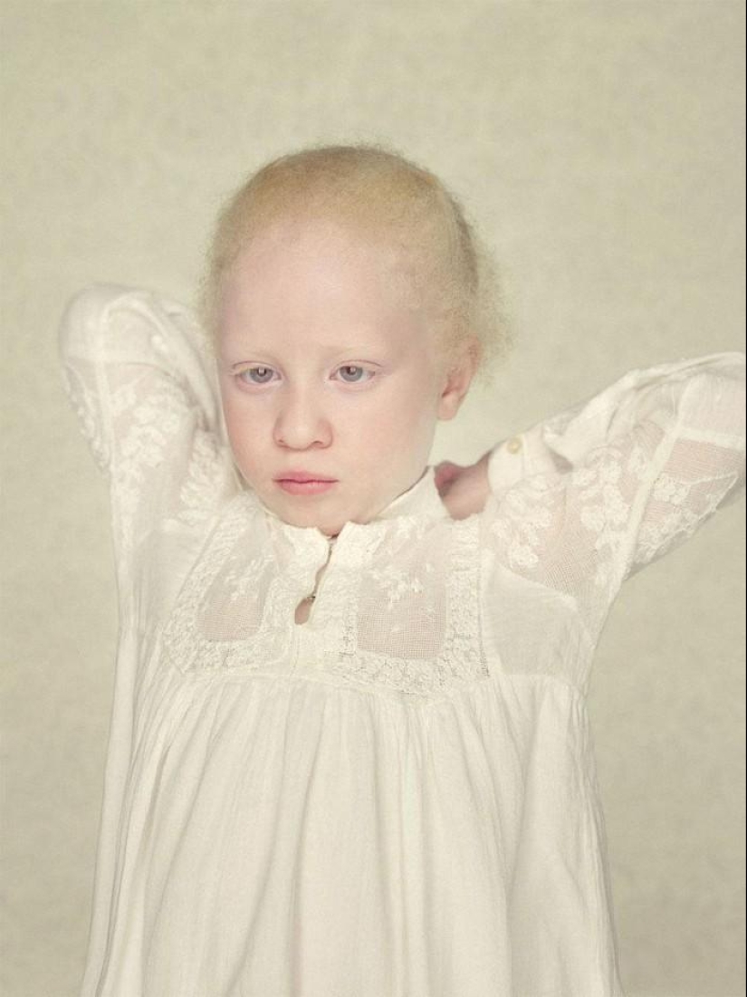 Not like everyone else: albino people Not like everyone else: albino people