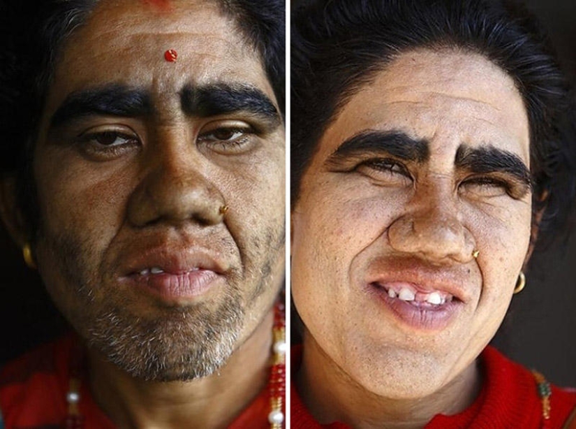 Personas lobo, víctimas de hipertricosis, se sometieron a depilación láser