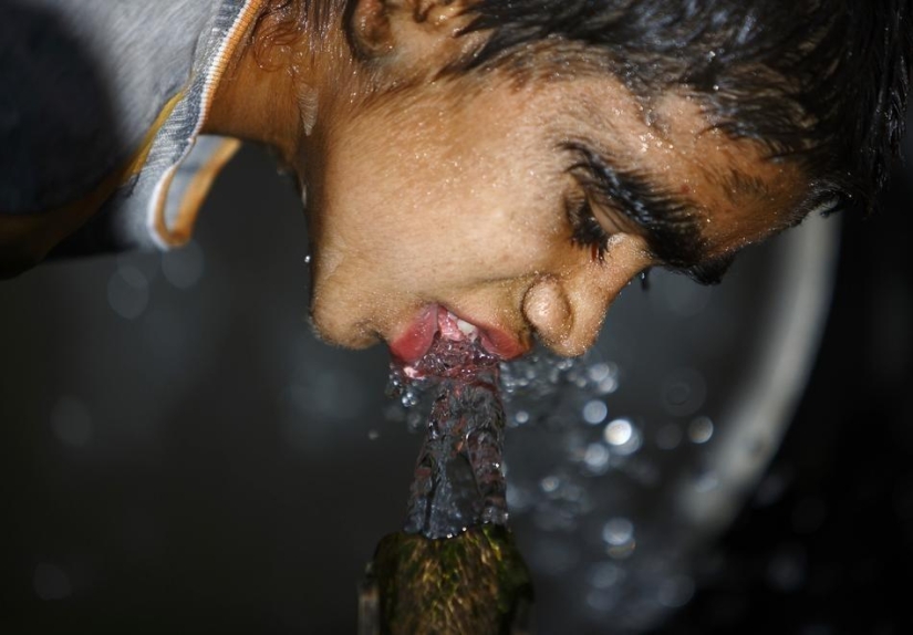 Personas lobo, víctimas de hipertricosis, se sometieron a depilación láser
