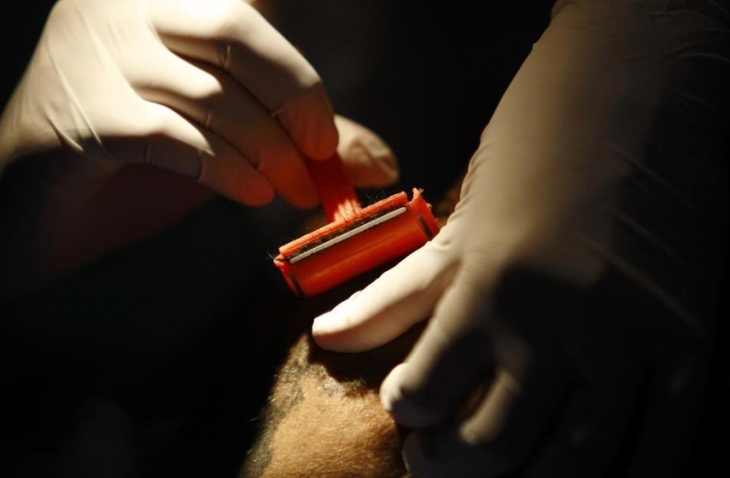 Personas lobo, víctimas de hipertricosis, se sometieron a depilación láser