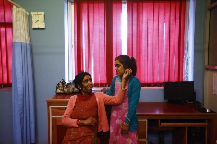 Personas lobo, víctimas de hipertricosis, se sometieron a depilación láser