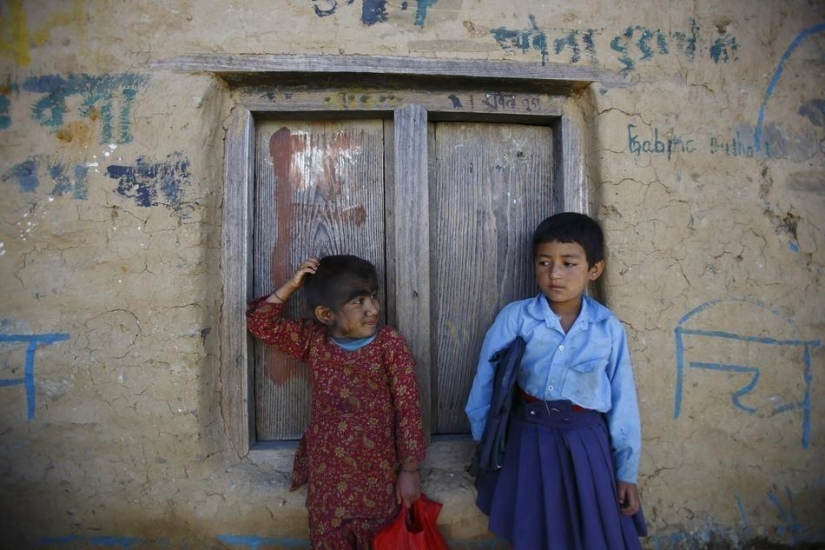Personas lobo, víctimas de hipertricosis, se sometieron a depilación láser