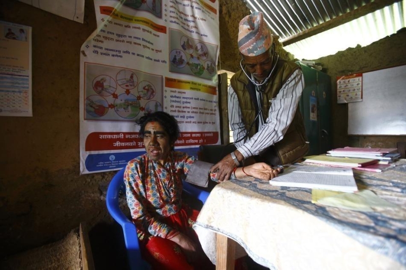 Personas lobo, víctimas de hipertricosis, se sometieron a depilación láser