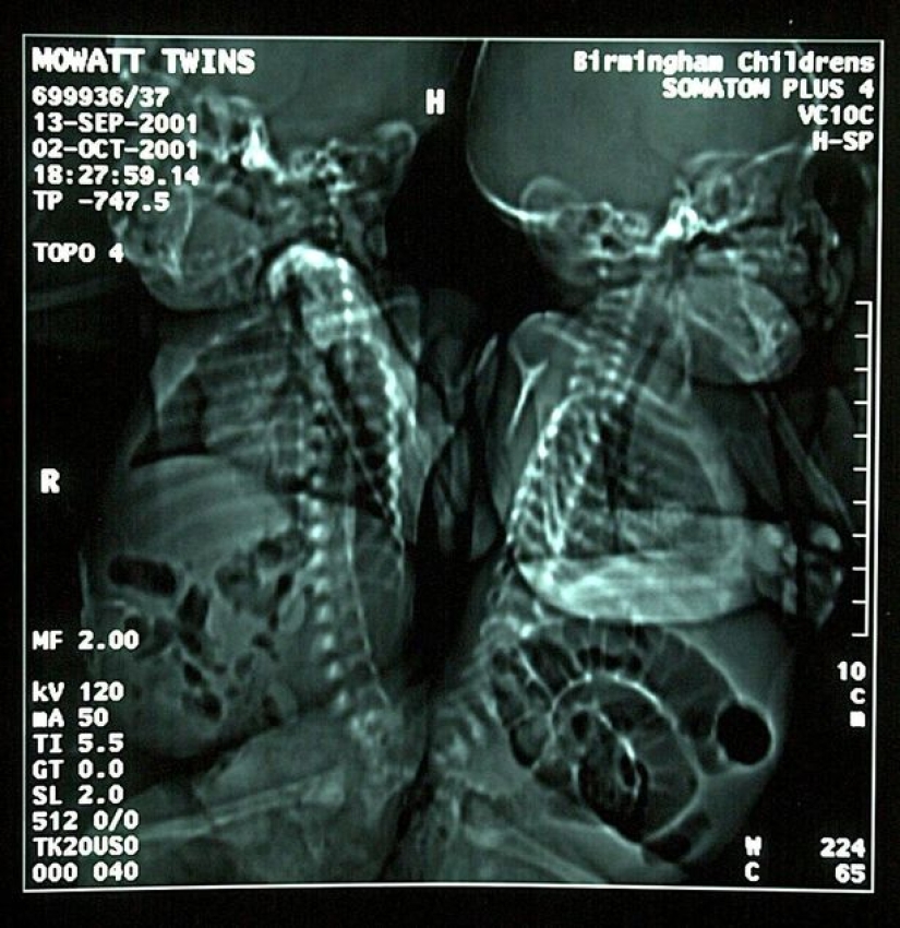 Siamese twins separated in infancy continue to sleep the same way as before the operation