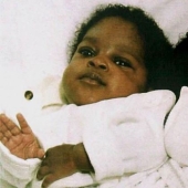 Siamese twins separated in infancy continue to sleep the same way as before the operation