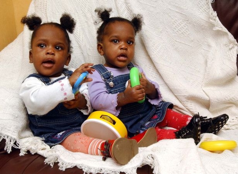 Siamese twins separated in infancy continue to sleep the same way as before the operation