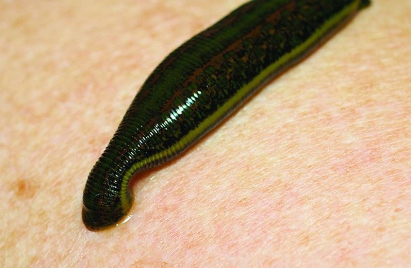 Strange medical procedures that were considered healing in the past Strange medical procedures that were considered healing in the past