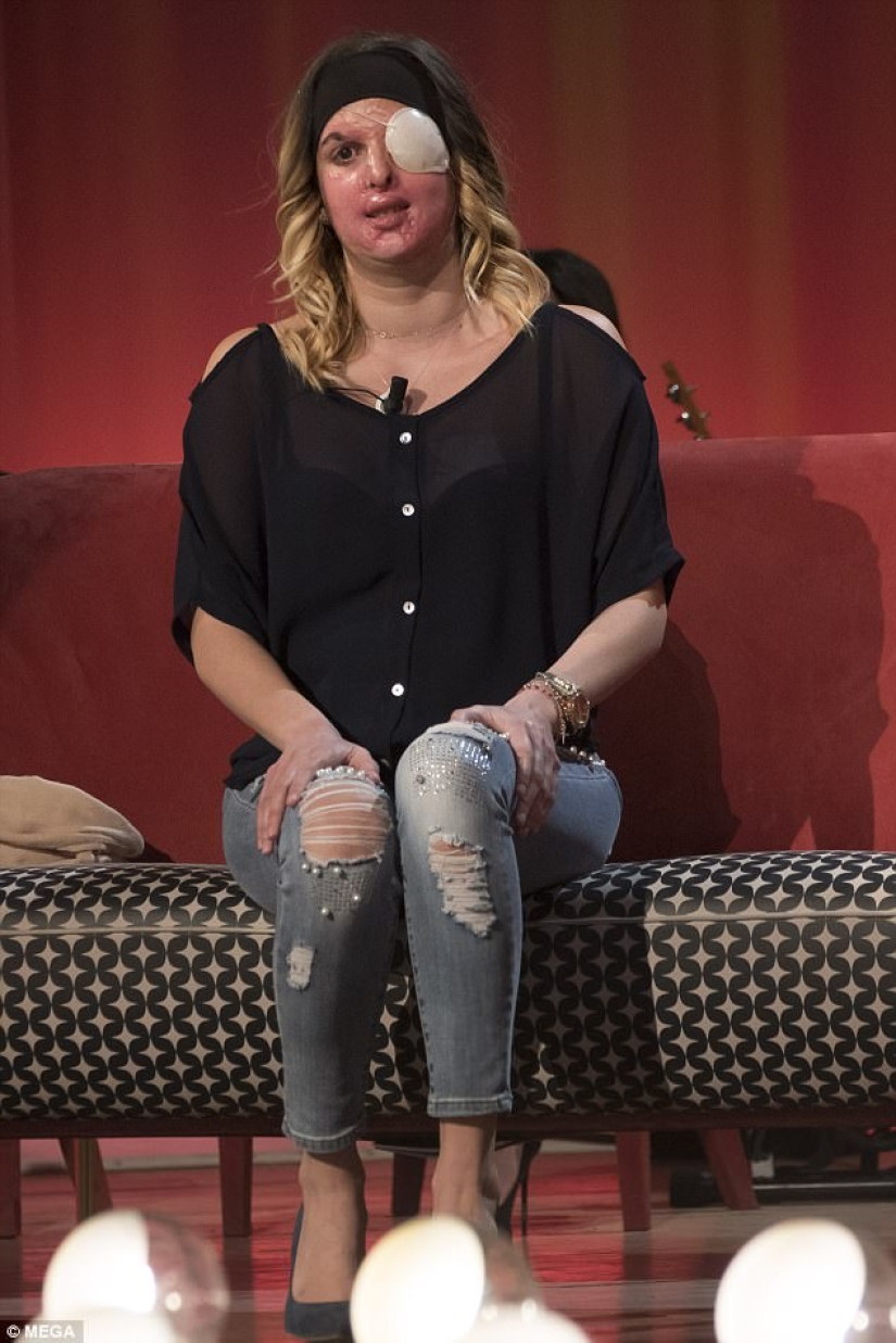 The beauty queen, who was doused with acid by her ex-fiance, showed a disfigured face The beauty queen, who was doused with acid by her ex-fiance, showed a disfigured face