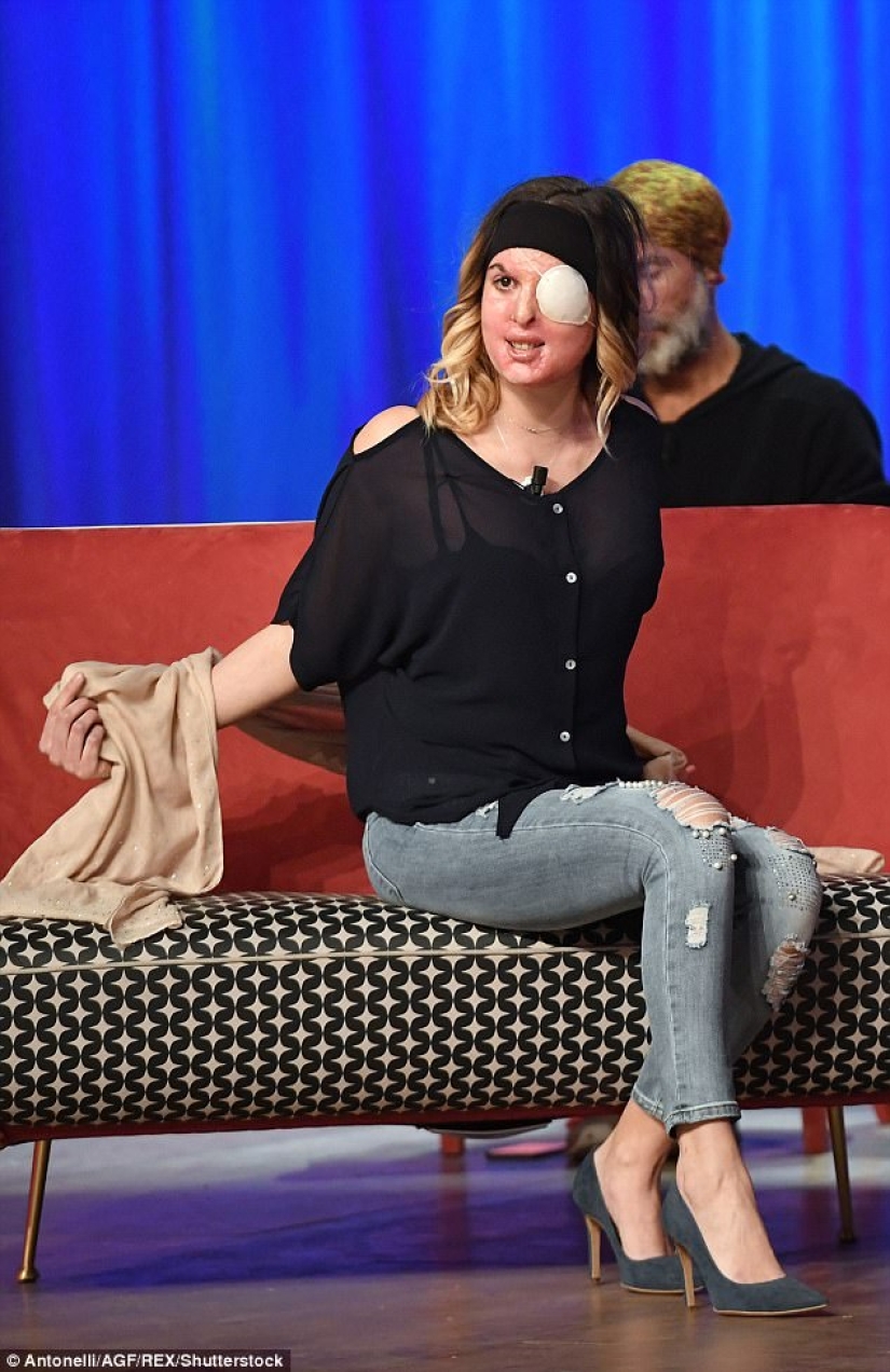 The beauty queen, who was doused with acid by her ex-fiance, showed a disfigured face The beauty queen, who was doused with acid by her ex-fiance, showed a disfigured face