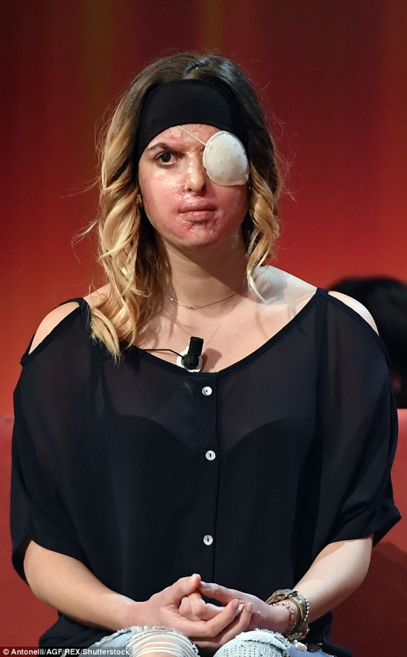 The beauty queen, who was doused with acid by her ex-fiance, showed a disfigured face The beauty queen, who was doused with acid by her ex-fiance, showed a disfigured face