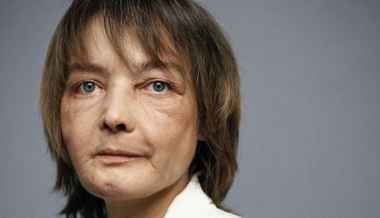 The first woman with a transplanted face died of cancer caused by anti-rejection drugs