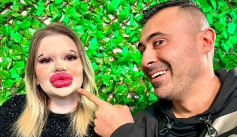 The girl with the biggest lips in the world decided to enlarge her cheekbones