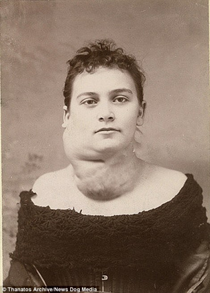 The harsh XIX century: a collection of archival photographs of people with deformities The harsh XIX century: a collection of archival photographs of people with deformities