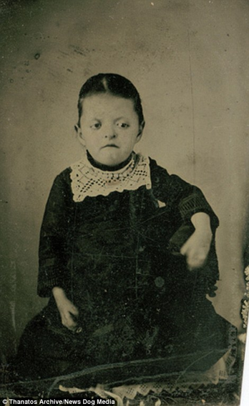The harsh XIX century: a collection of archival photographs of people with deformities The harsh XIX century: a collection of archival photographs of people with deformities