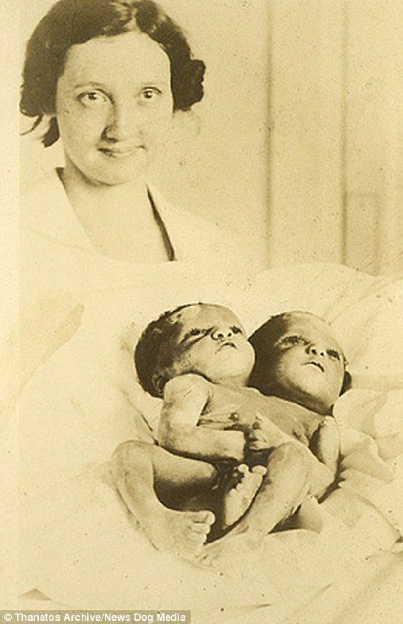 The harsh XIX century: a collection of archival photographs of people with deformities The harsh XIX century: a collection of archival photographs of people with deformities