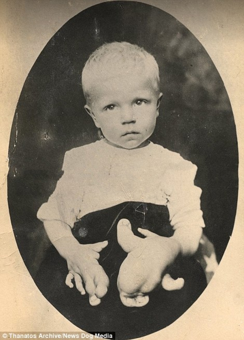 The harsh XIX century: a collection of archival photographs of people with deformities The harsh XIX century: a collection of archival photographs of people with deformities