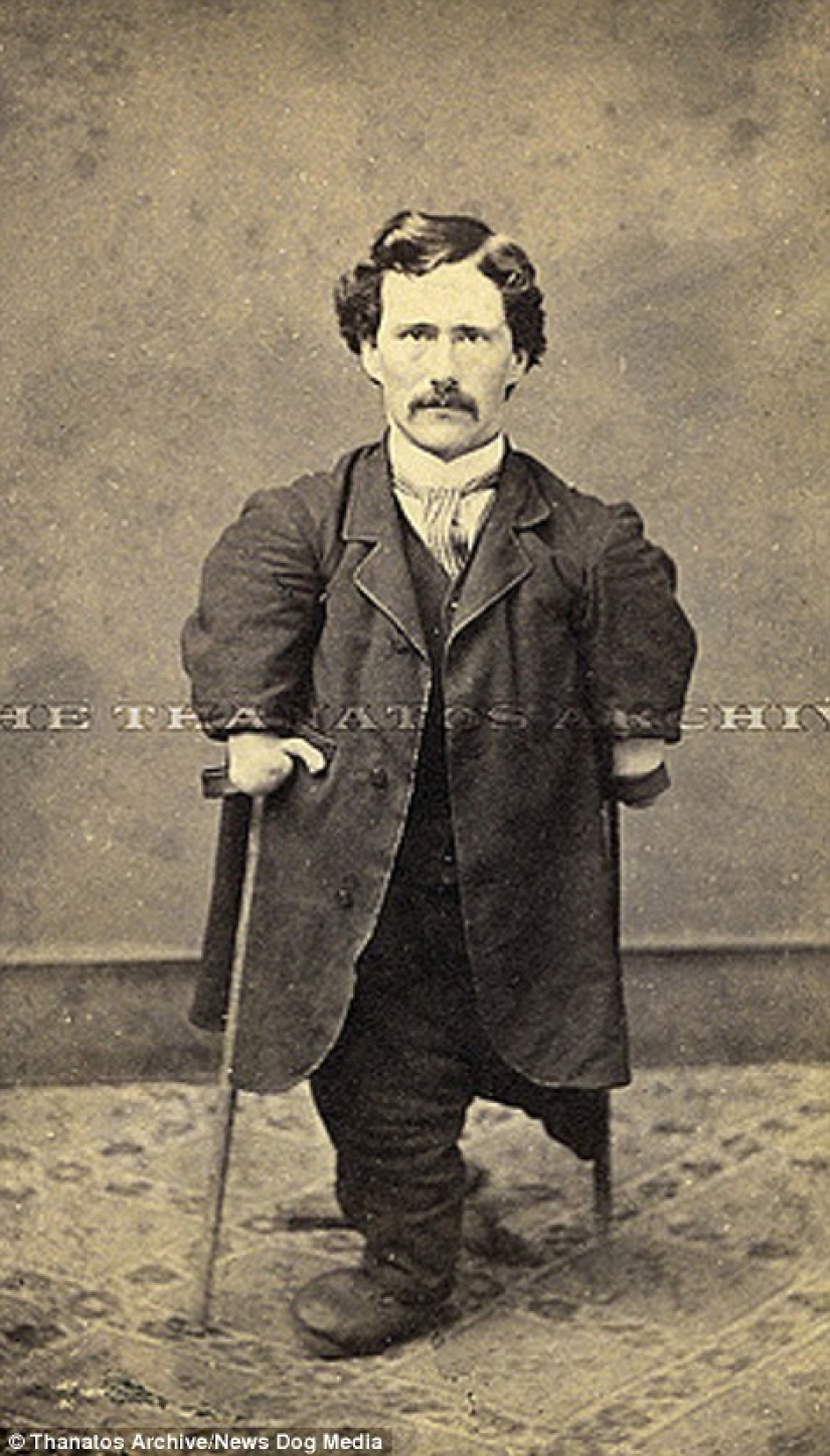 The harsh XIX century: a collection of archival photographs of people with deformities The harsh XIX century: a collection of archival photographs of people with deformities
