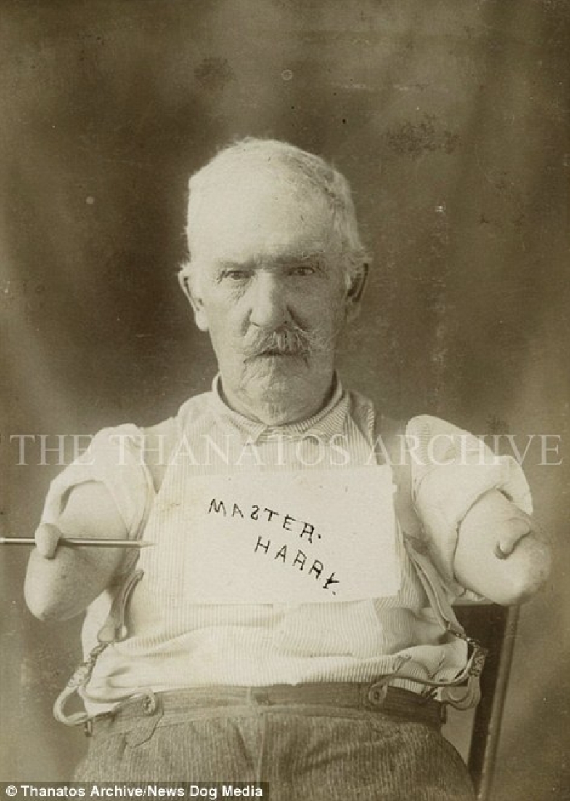 The harsh XIX century: a collection of archival photographs of people with deformities The harsh XIX century: a collection of archival photographs of people with deformities
