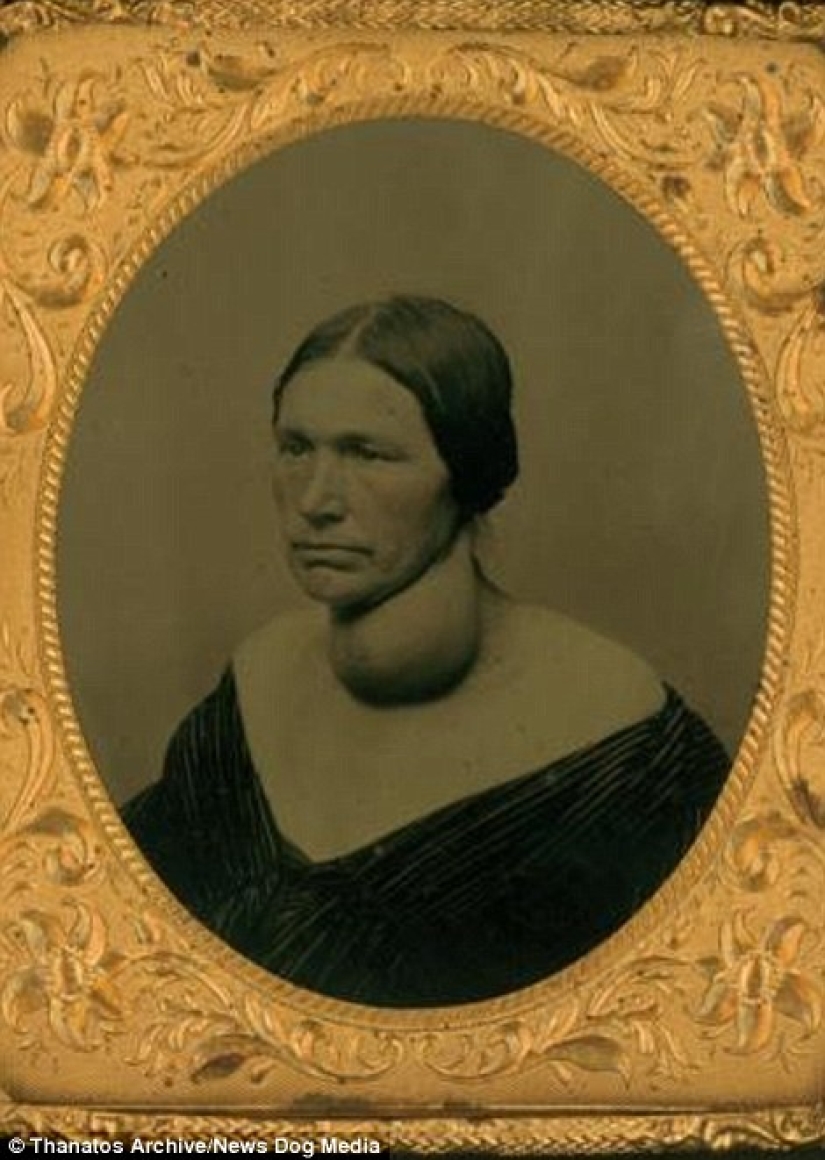 The harsh XIX century: a collection of archival photographs of people with deformities The harsh XIX century: a collection of archival photographs of people with deformities
