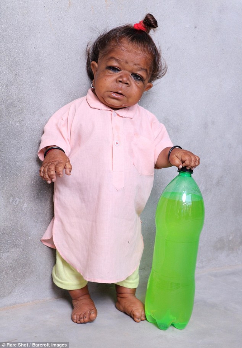 The inexplicable story of a 21-year-old Indian who got stuck in the body of a baby The inexplicable story of a 21-year-old Indian who got stuck in the body of a baby