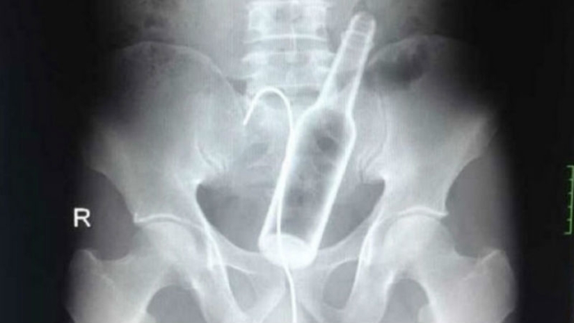 The most creepy objects that have ever been found in a human stomach