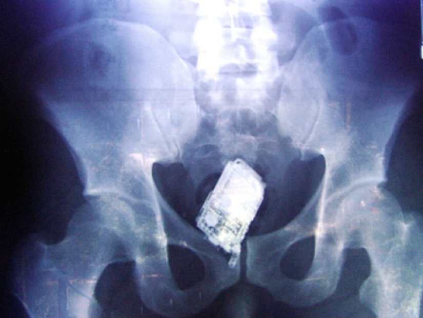 The most creepy objects that have ever been found in a human stomach