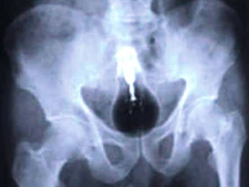 The most creepy objects that have ever been found in a human stomach