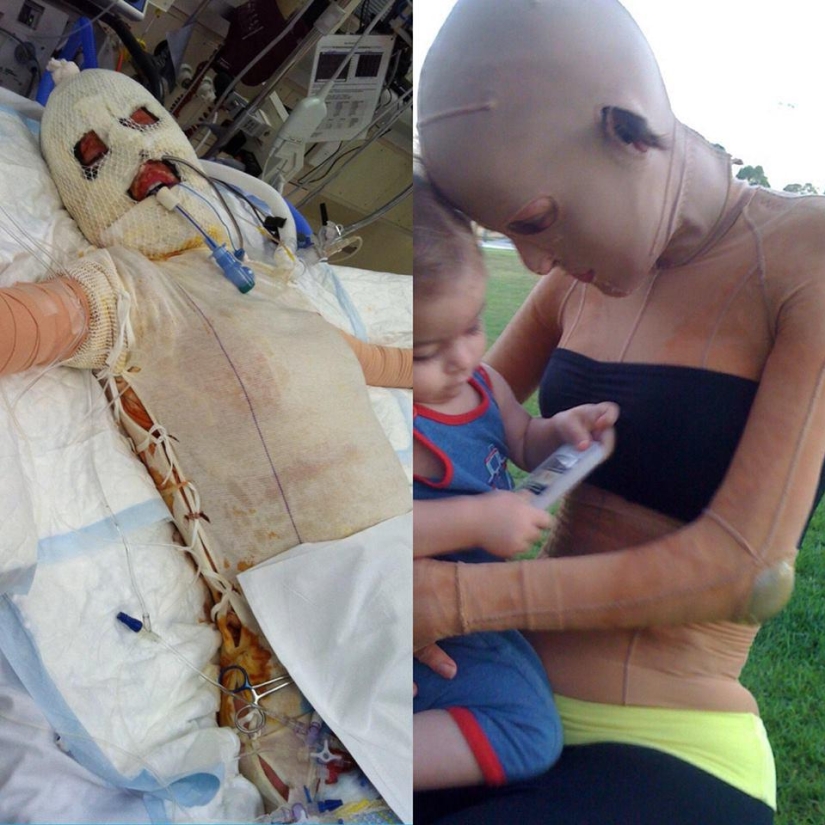 The once almost burned alive Australian woman finally took off her mask