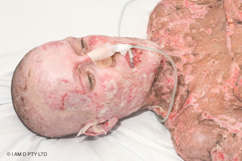 The once almost burned alive Australian woman finally took off her mask