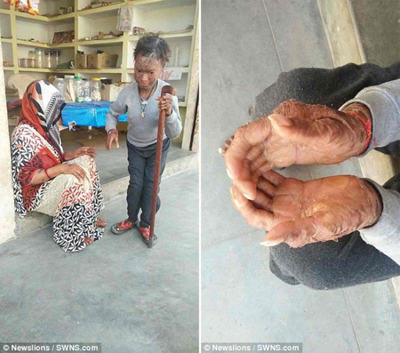 The snake girl sheds her skin every six weeks The snake girl sheds her skin every six weeks