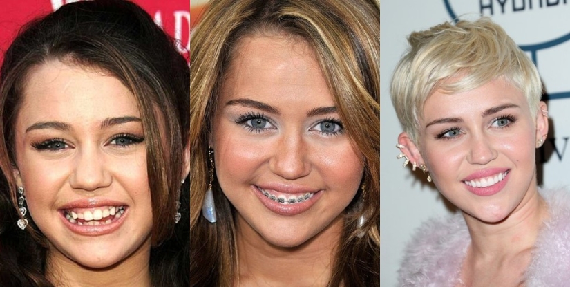 These celebrities will show you how braces can dramatically change your smile These celebrities will show you how braces can dramatically change your smile
