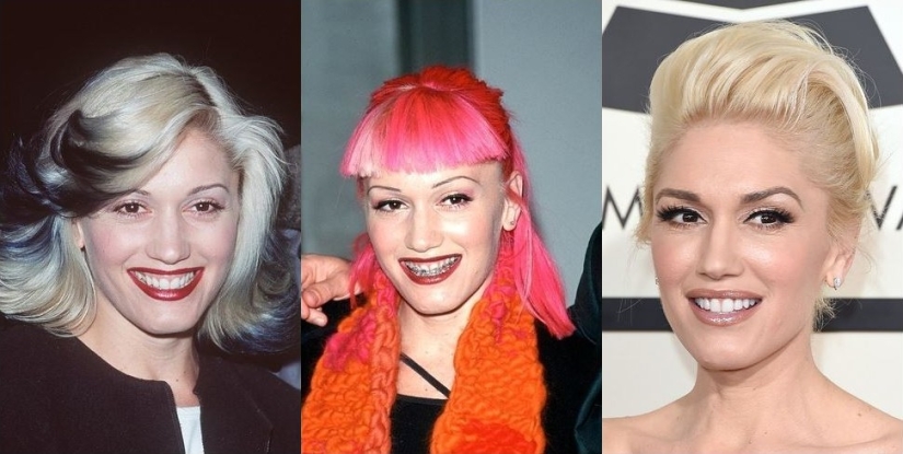 These celebrities will show you how braces can dramatically change your smile These celebrities will show you how braces can dramatically change your smile