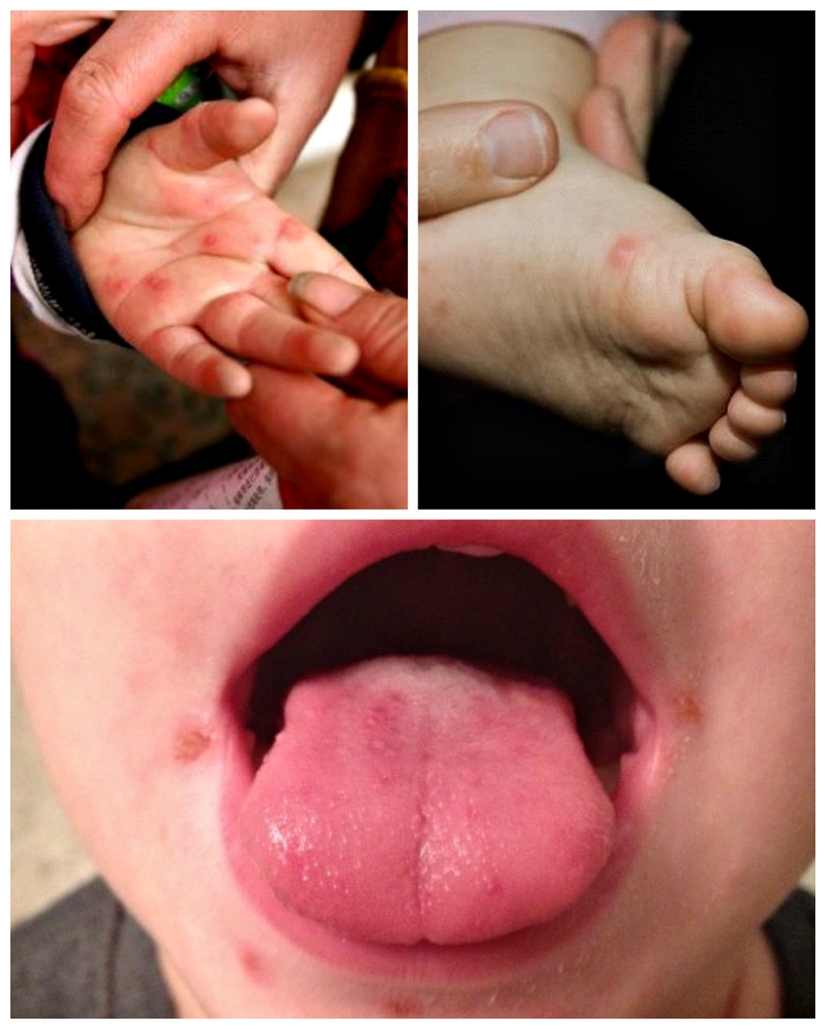 Todo lo que necesita saber sobre el virus Coxsackie