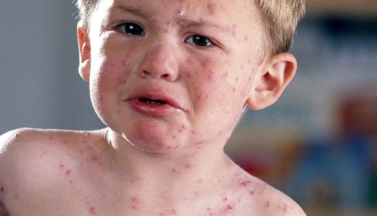 Todo lo que necesita saber sobre el virus Coxsackie Todo lo que necesita saber sobre el virus Coxsackie