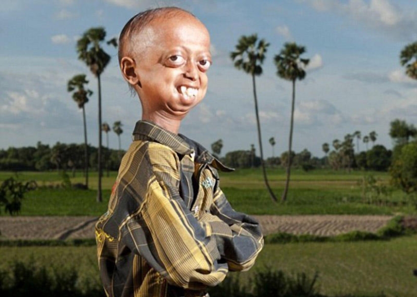 Una enfermedad muy rara convirtió al niño en un pensionista