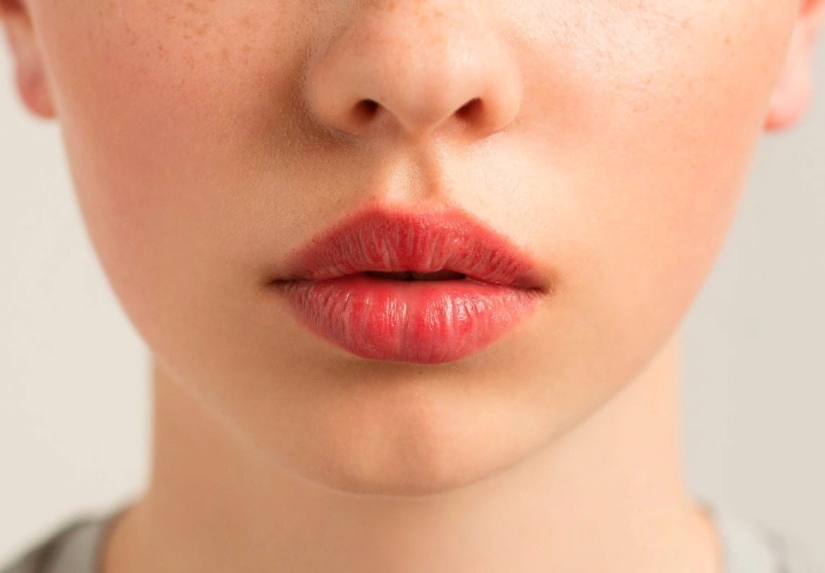 We remove a sad, dissatisfied face along with nasolabial wrinkles and increase the volume of the lips We remove a sad, dissatisfied face along with nasolabial wrinkles and increase the volume of the lips