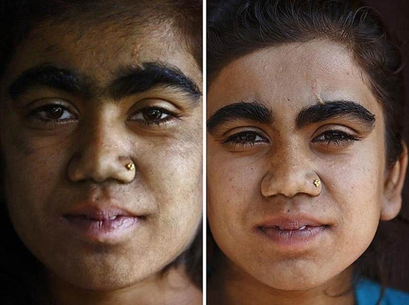 Wolf people, victims of hypertrichosis, underwent laser hair removal