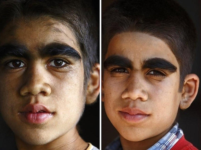 Wolf people, victims of hypertrichosis, underwent laser hair removal