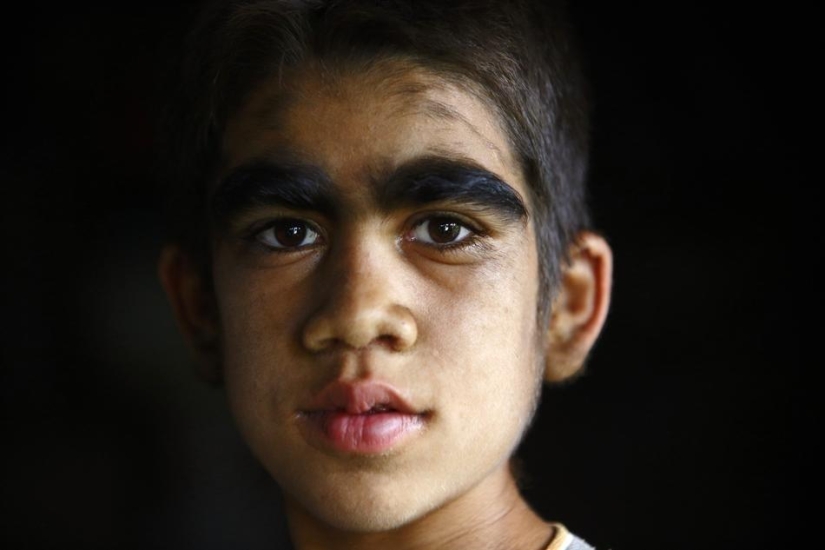 Wolf people, victims of hypertrichosis, underwent laser hair removal